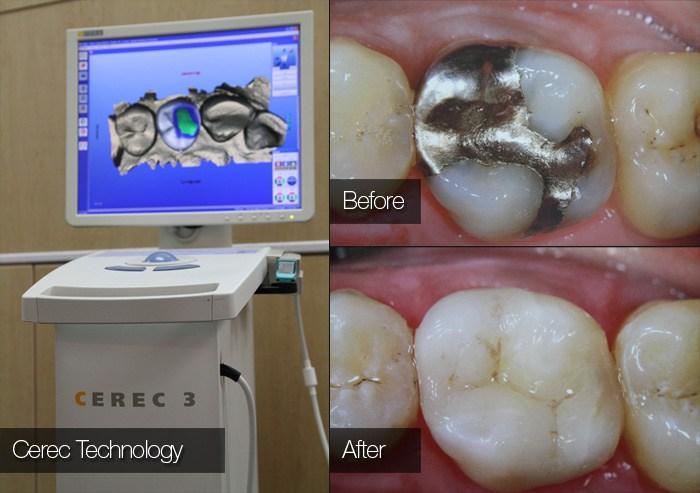 Cerec